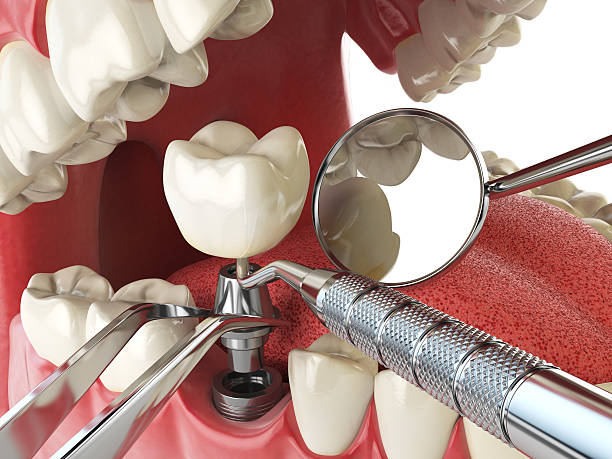 Best Emergency Tooth Extraction in Three Forks, MT